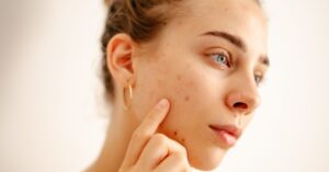 how to prevent acne naturally