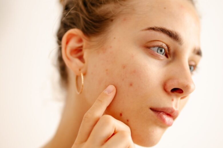 how to prevent acne naturally