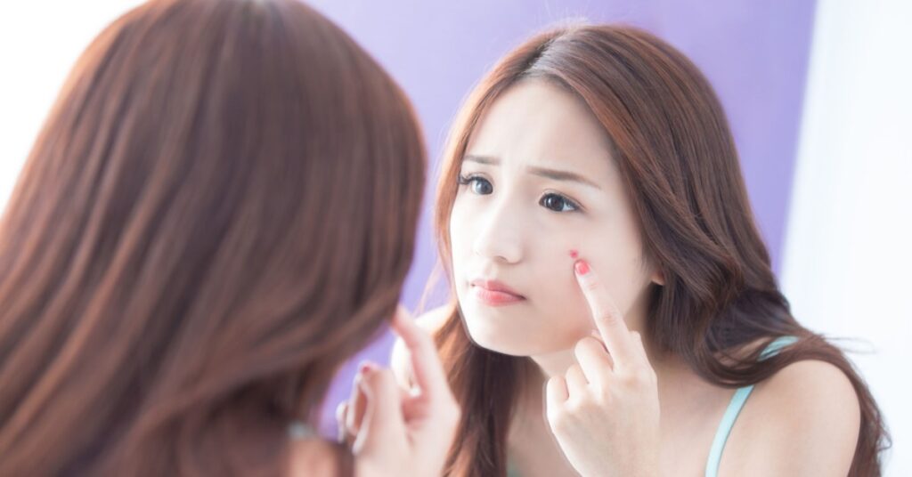 pop pimples if required to prevent acne naturally