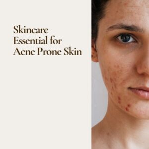 how to prevent acne naturally