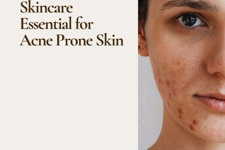 how to prevent acne naturally